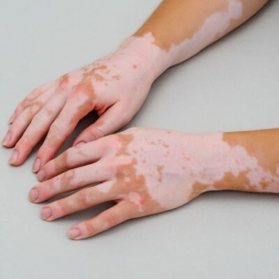 Vitiligo – Causes, symptoms, and management